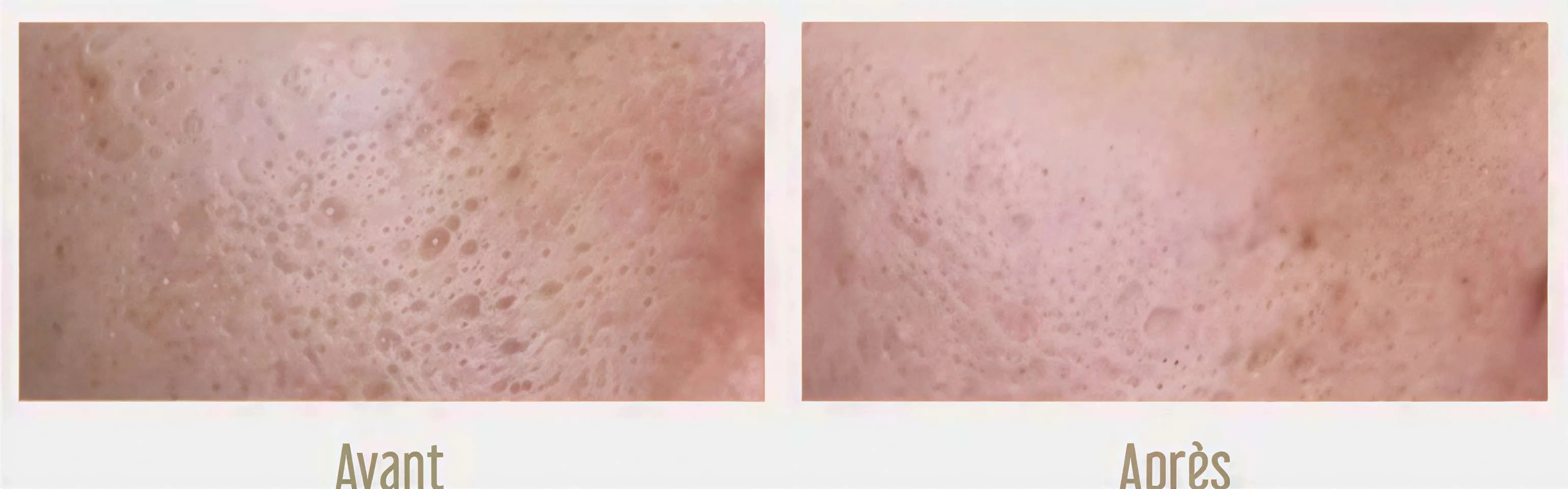 Aperçu Grain Acnée et texture secret DUO